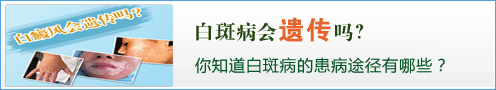白癜风会遗传吗